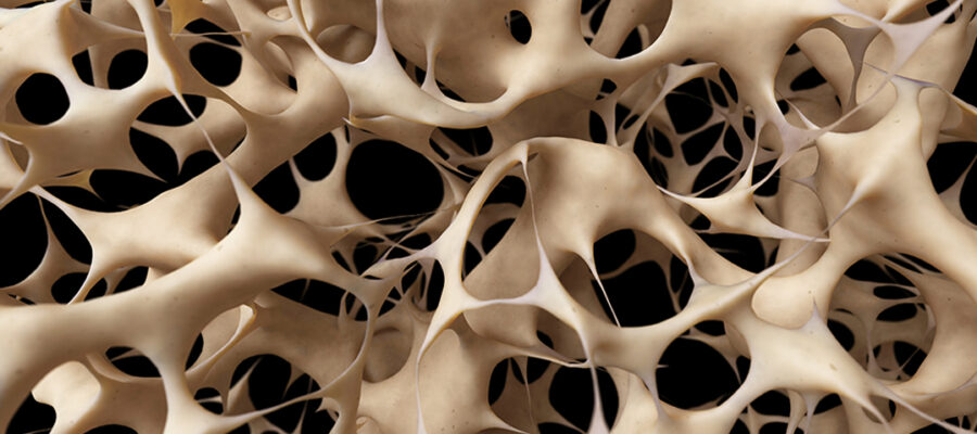 what osteoporosis looks like in bones.