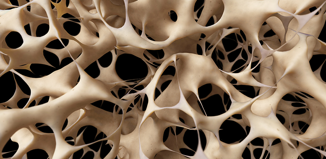 what osteoporosis looks like in bones.